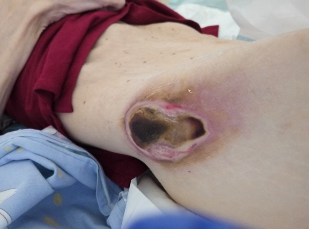 пролежень в тест.png