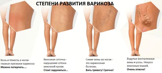 Stadii-razvitiya-trofieskih-yazv-pri-venoznoj-patologii.jpg.jpg
