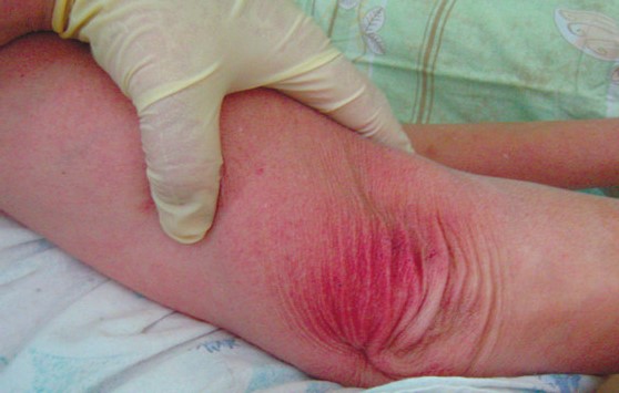 Раздражающий дерматит половых органов — причины, симптомы и лечение
