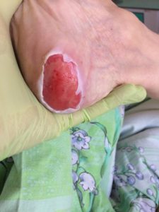 Лечение пролежня между пальцами ног thumbnail